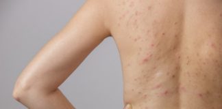 How to Get Rid of Back Acne: 11 Tips and Remedies that Work