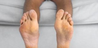 Tinea Pedis: 7 Remedies for Athlete’s Foot to Ease Symptoms