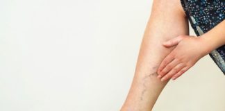 How to Get Rid of Varicose Veins: 9 Home Remedies That Work