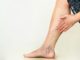 How to Get Rid of Varicose Veins: 9 Home Remedies That Work