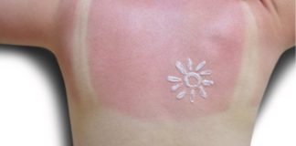 Too Much Sun! 8 Natural Sunburn Remedies That Work Fast