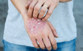 How to Get Rid of Psoriasis: 9 Tips and Remedies to Try