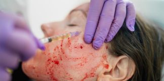 Vampire Facials May Be Bloody Bad for You