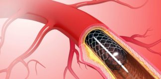 Heart Stents Fail to Alleviate Chest Pain, New Study Finds