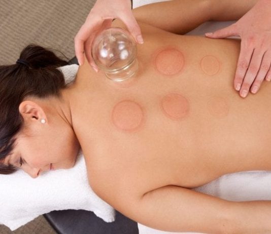 Is Cupping the New Foam Roller